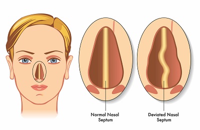 Thực hiện phẫu thuật vẹo vách ngăn mũi ở đâu tốt?